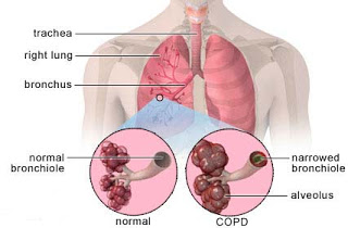 Nursing Intervention for COPD